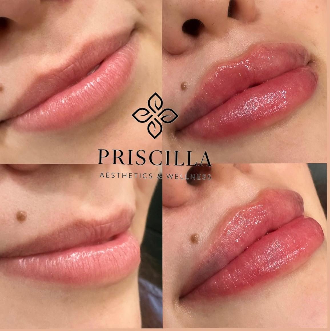 Lip enhancement before-and-after photos